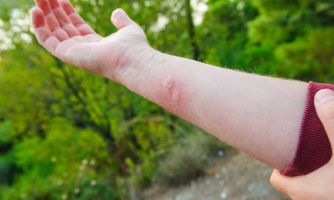 Τσιμπήματα εντόμων: Πώς φαίνεται το κάθε είδος στο δέρμα (εικόνες)